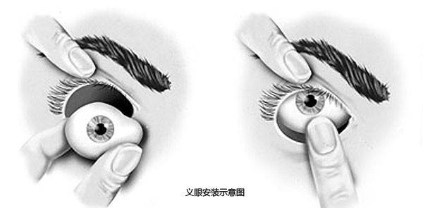 真假難辨，義眼移植術(shù)帶你重拾自信